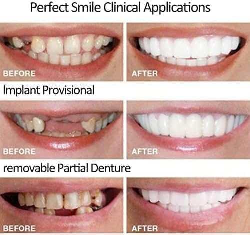 Carillas Dentales Estéticas 50% Descuento